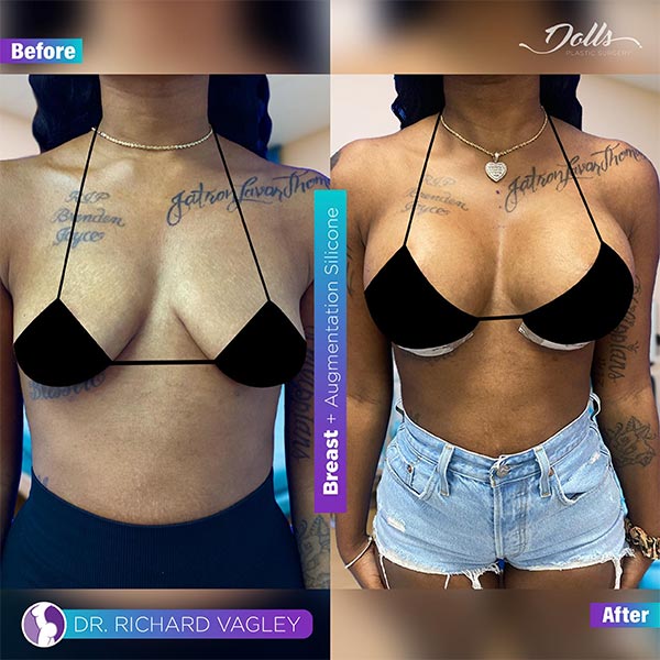 Breast Augmentation-Dr Vagley