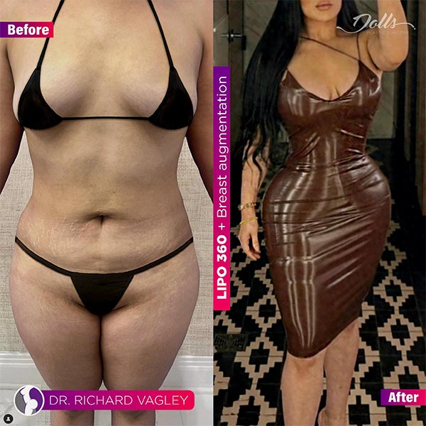 Breast Augmentation-Dr Vagley