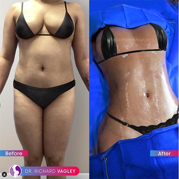 Breast Augmentation-Dr Vagley
