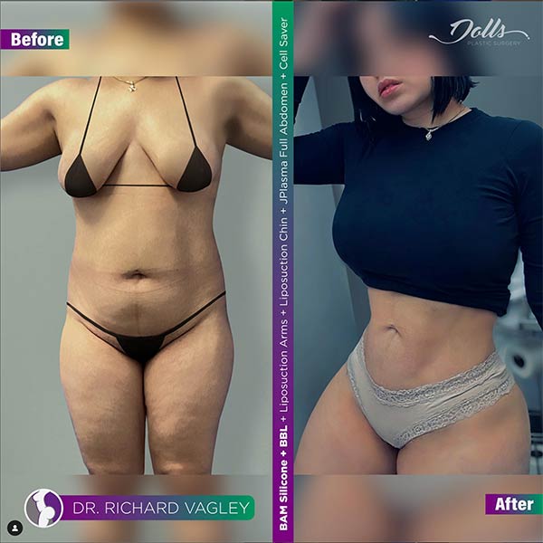 Breast Augmentation-Dr Vagley