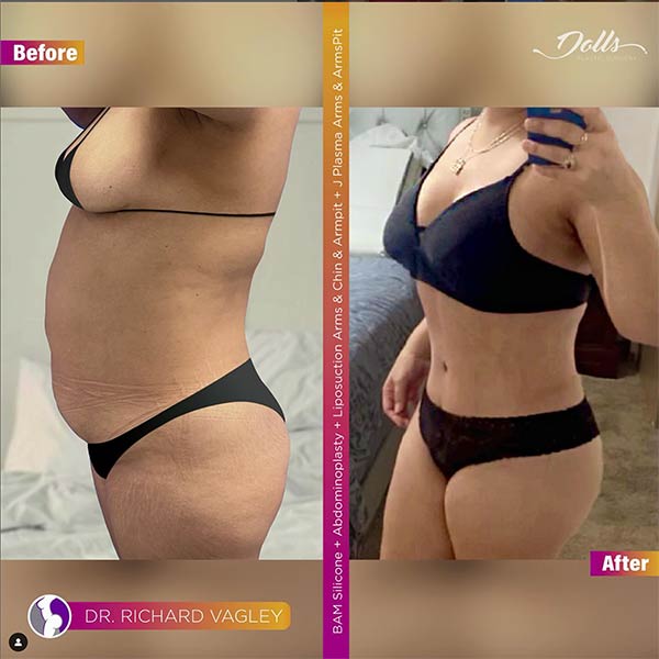 Breast Augmentation-Dr Vagley