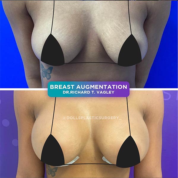 Breast Augmentation-Dr Vagley