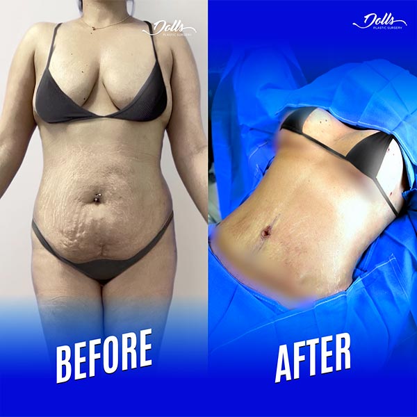 Breast Lift-Dr Leonard Tachmes