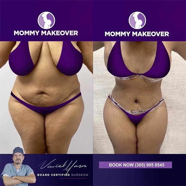 Mommy Makeover-Dr Nidal Masri