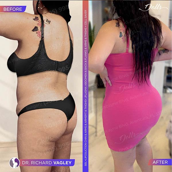 Brazilian Butt Lift-Dr Richard Vagley