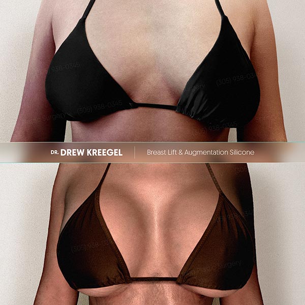 Results Breast Lift - Dr. Kreegel
