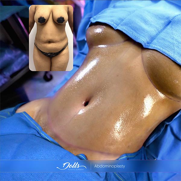 Resultados de Abdominoplasty