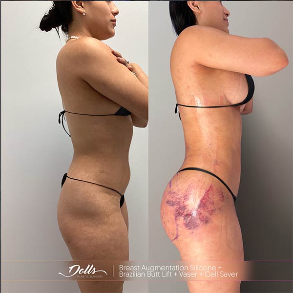 Resultados de BBL y Breast Augmentation