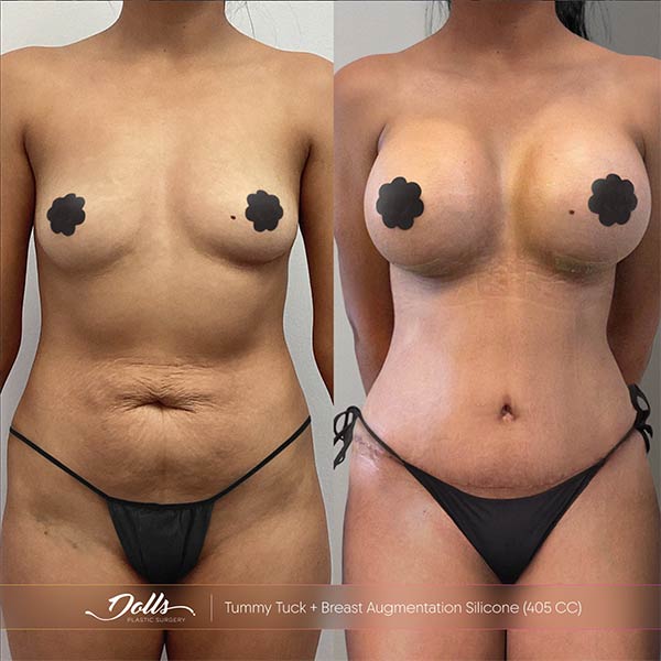 Resultado de aumento de busto