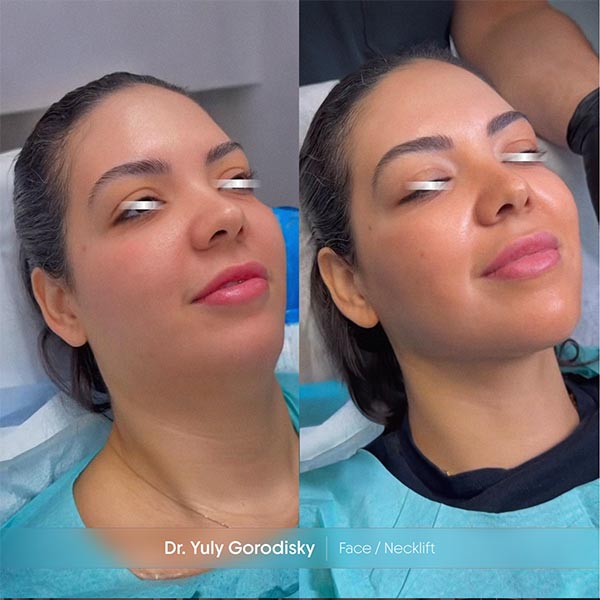 Facelift - Necklift - Dr. Gorodisky