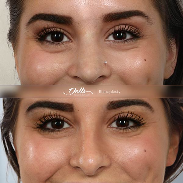 Rhinoplasty - Dr. Espinoza